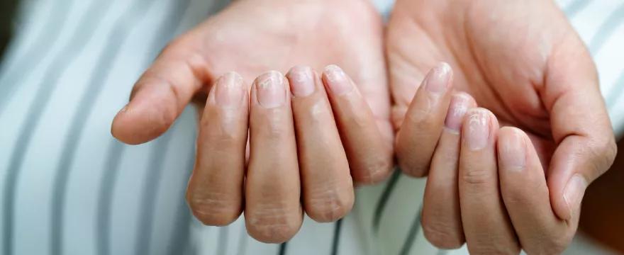 Niedobór żelaza u kobiet i mam – objawy, badania i dieta