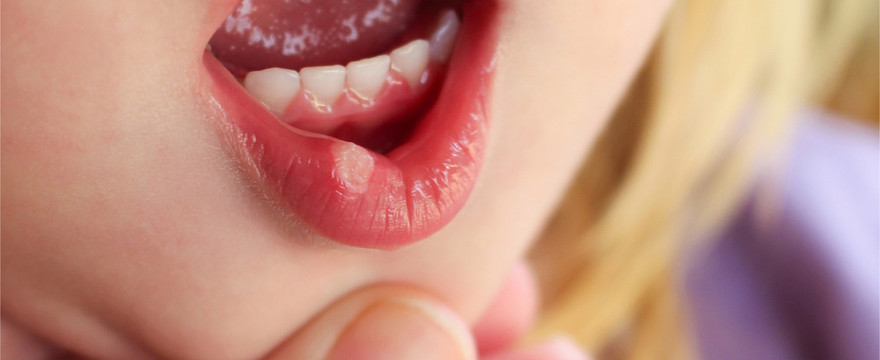 Zapalenie jamy ustnej u dziecka - przyczyny, objawy, leczenie
